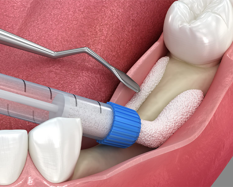 뼈이식 임플란트 정의 이미지