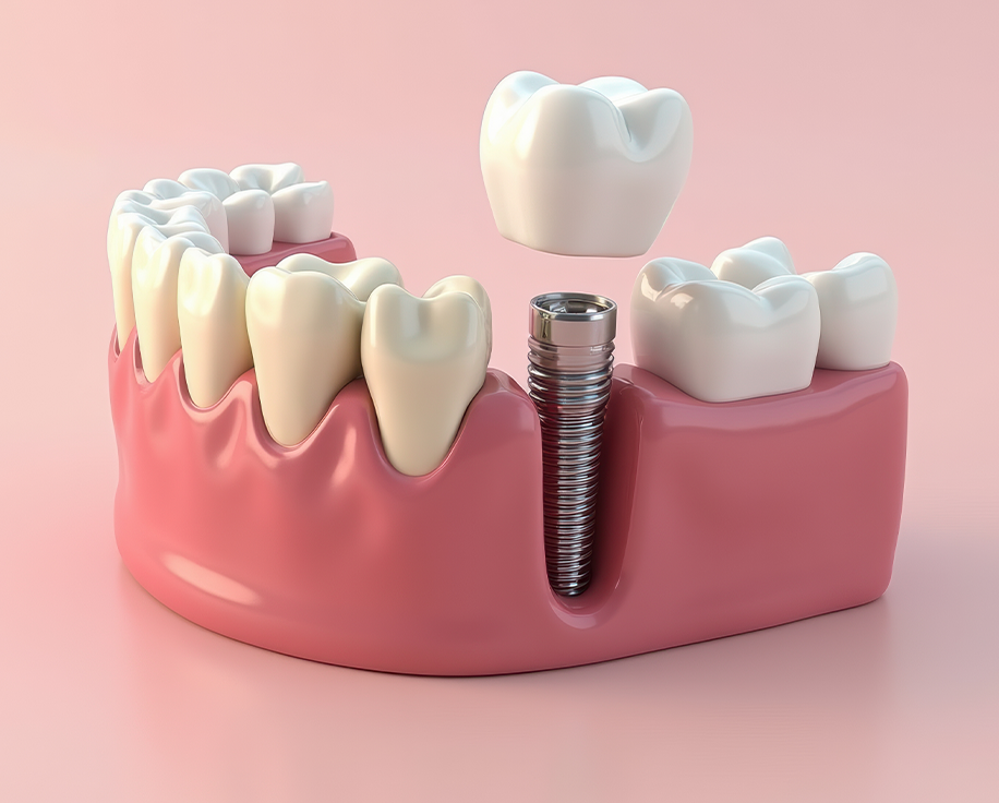 발치즉시 임플란트 정의 이미지