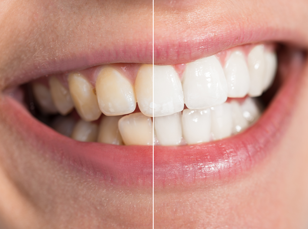 전문가 미백 이미지